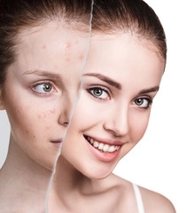 Woman face with acne and pustules