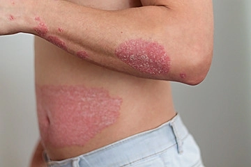 Mann mit Psoriasis und Schuppenflechte am Körper