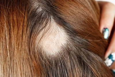 alopecia areata Kopf