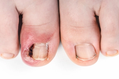 Ingrown toenail