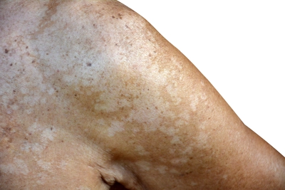 Kleienflechte oder Pityriasis versicolor