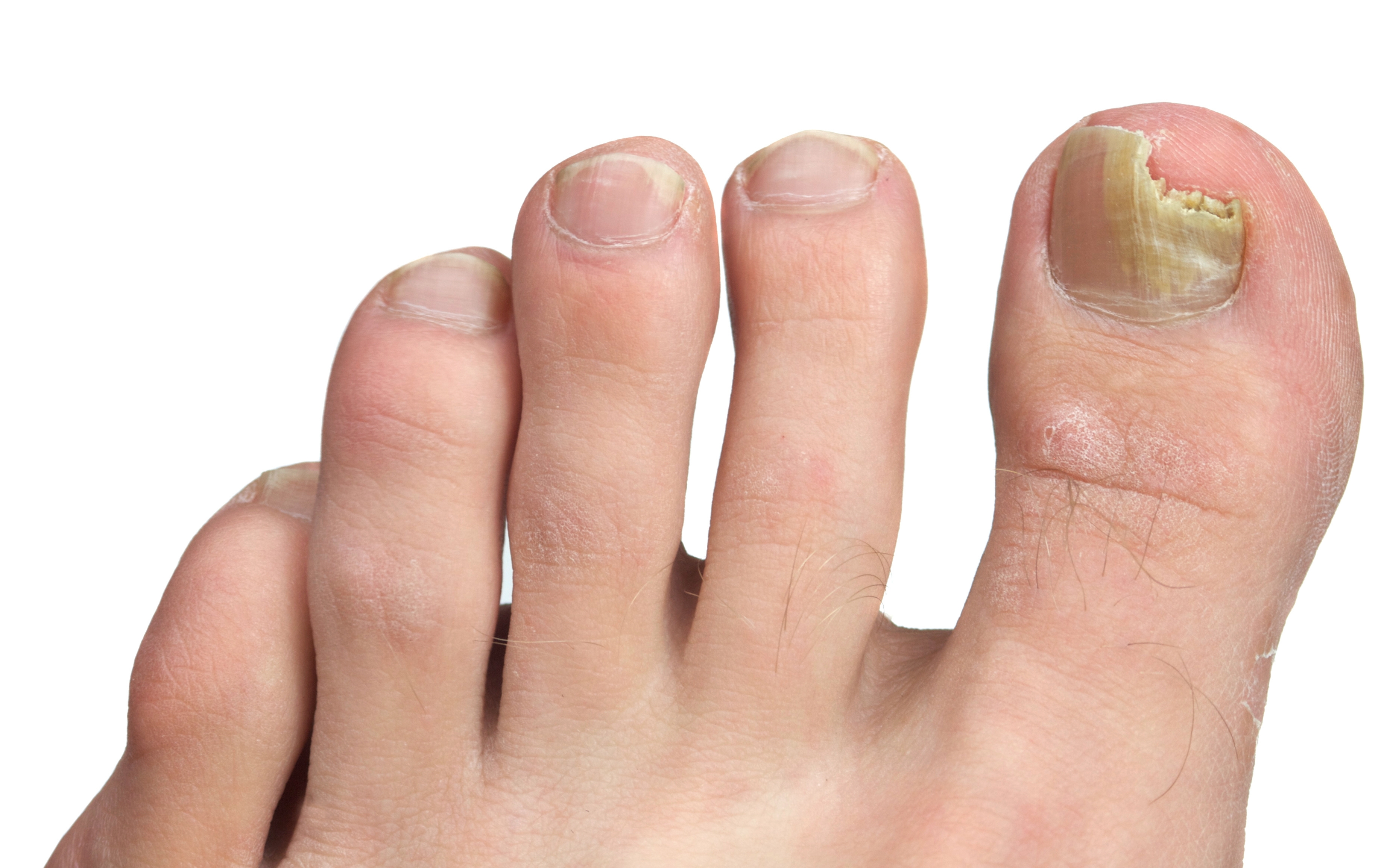 Man foot with nail fungus