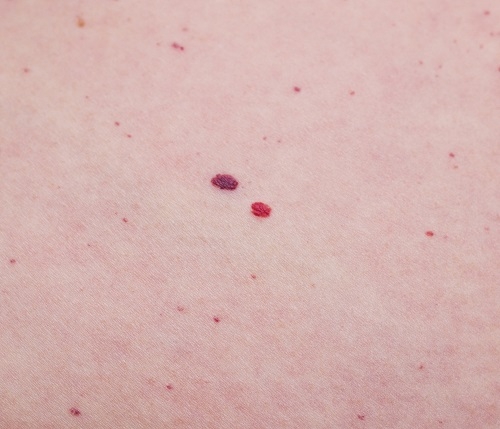 Haut rote punkte auf der Rote Punkte