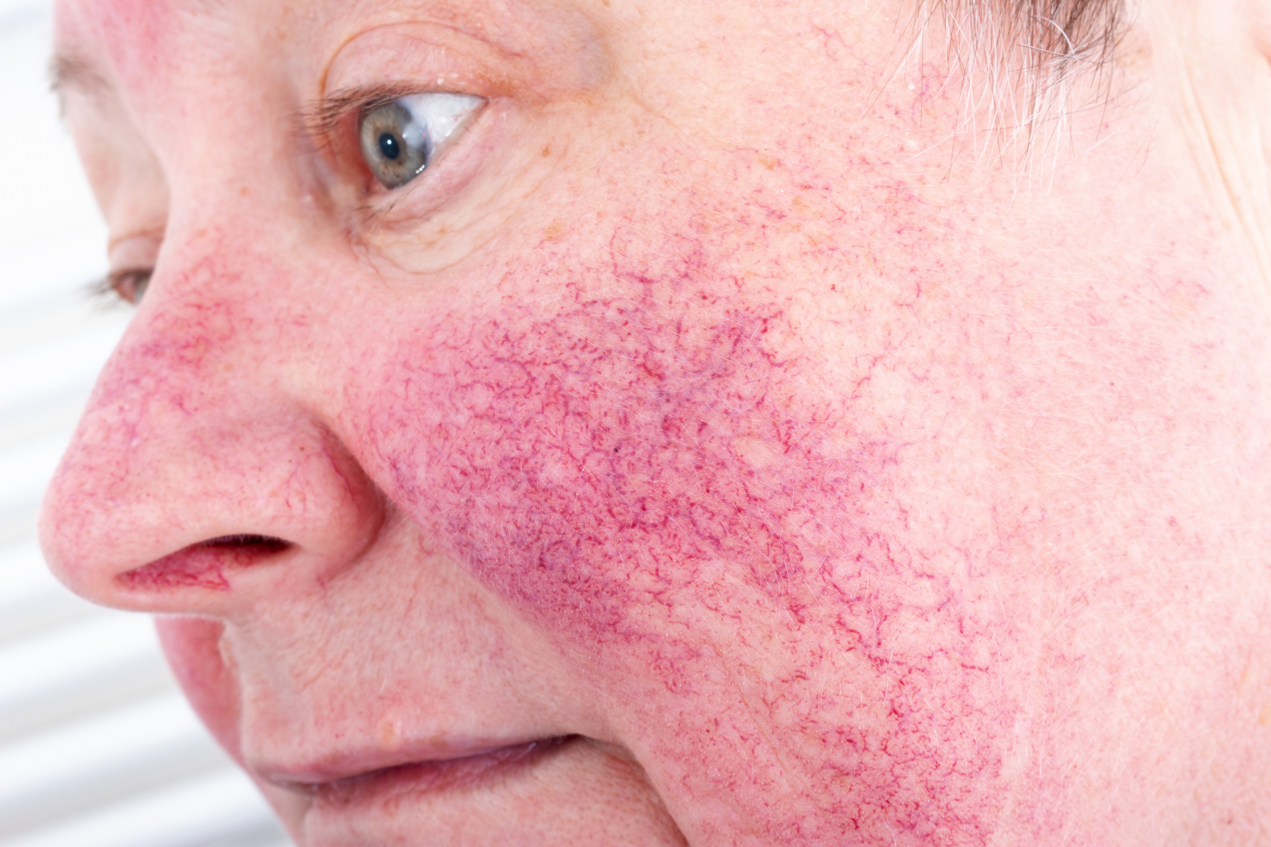 Rosacea, redness, small vessels and discomfort and burning