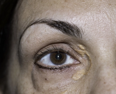 Xanthelasma Auge Cholesterinablagerung