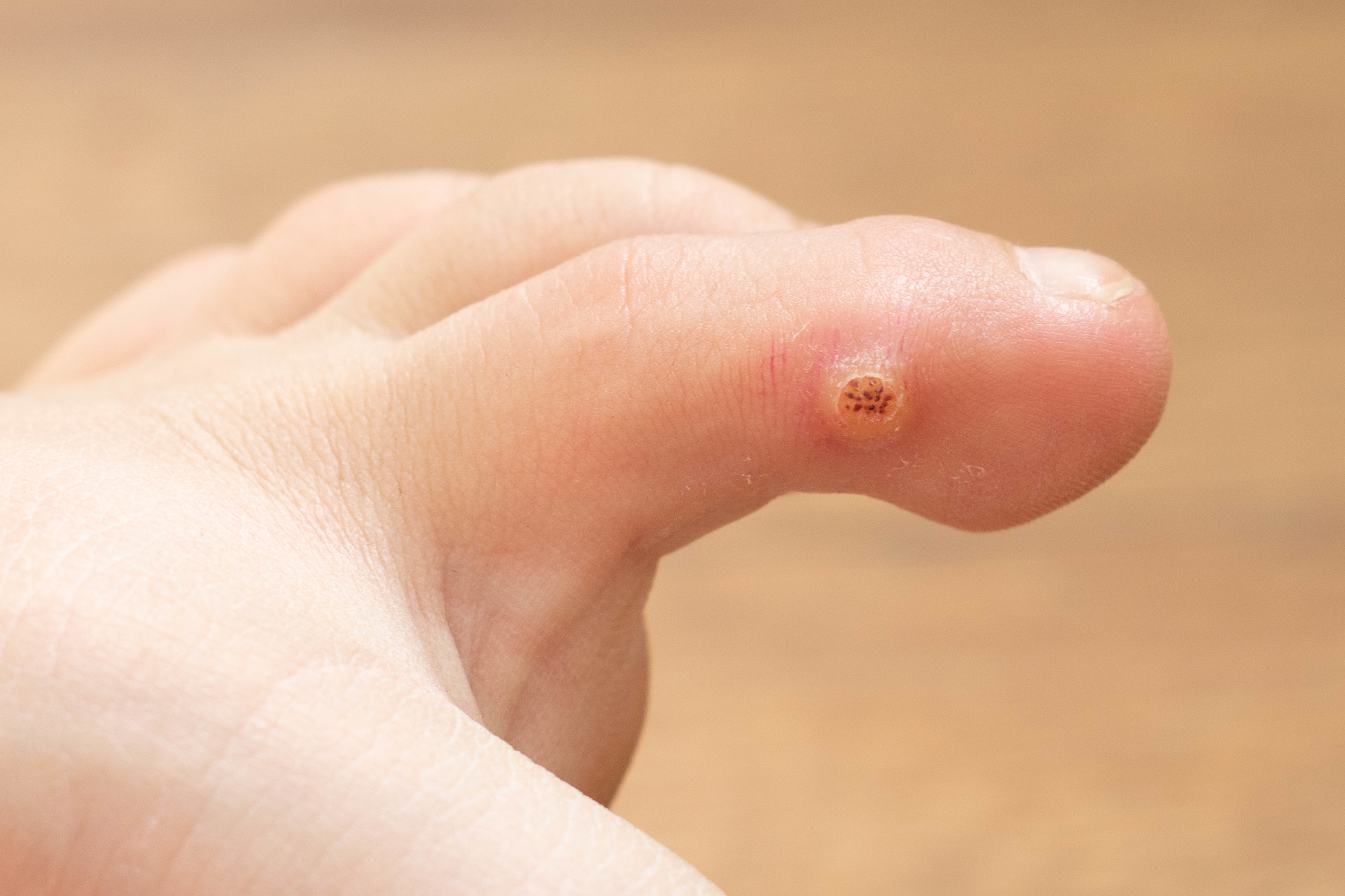Child toe with wart