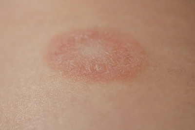 Pityriasis rosea oder Röschenflechte