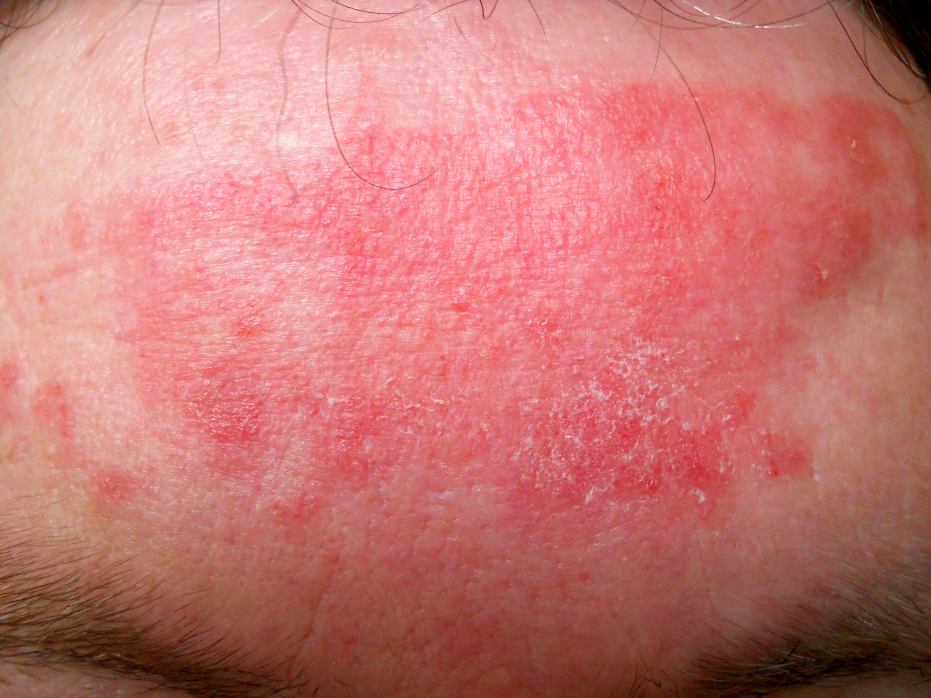 Atopic dermatitis or eczema can be treated! Atopic dermatitis or eczema can be treated!