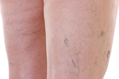 Woman with Varicose veins