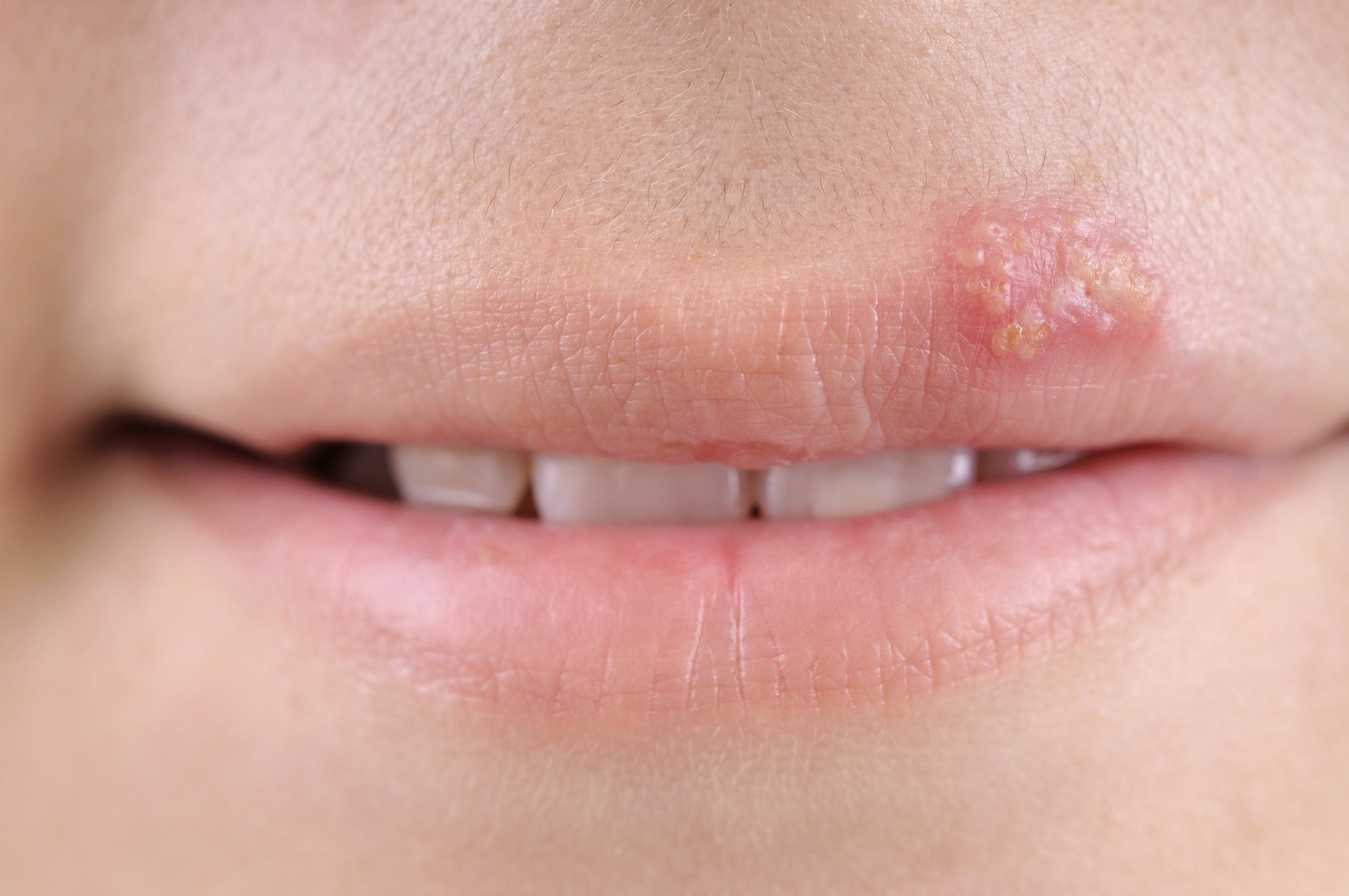 Herpes Lippe
