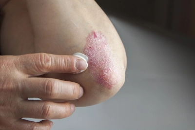 Creame Psoriasis Ellenbogen