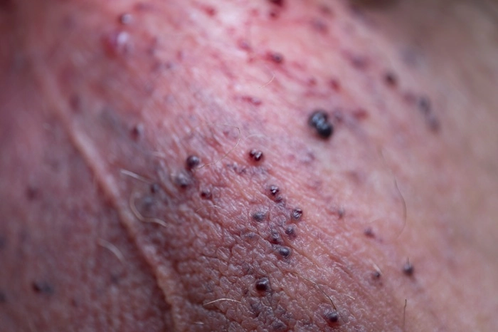 Angiokeratome: kleine dunkelrote bis violette Gefäßpunkte auf der Haut
